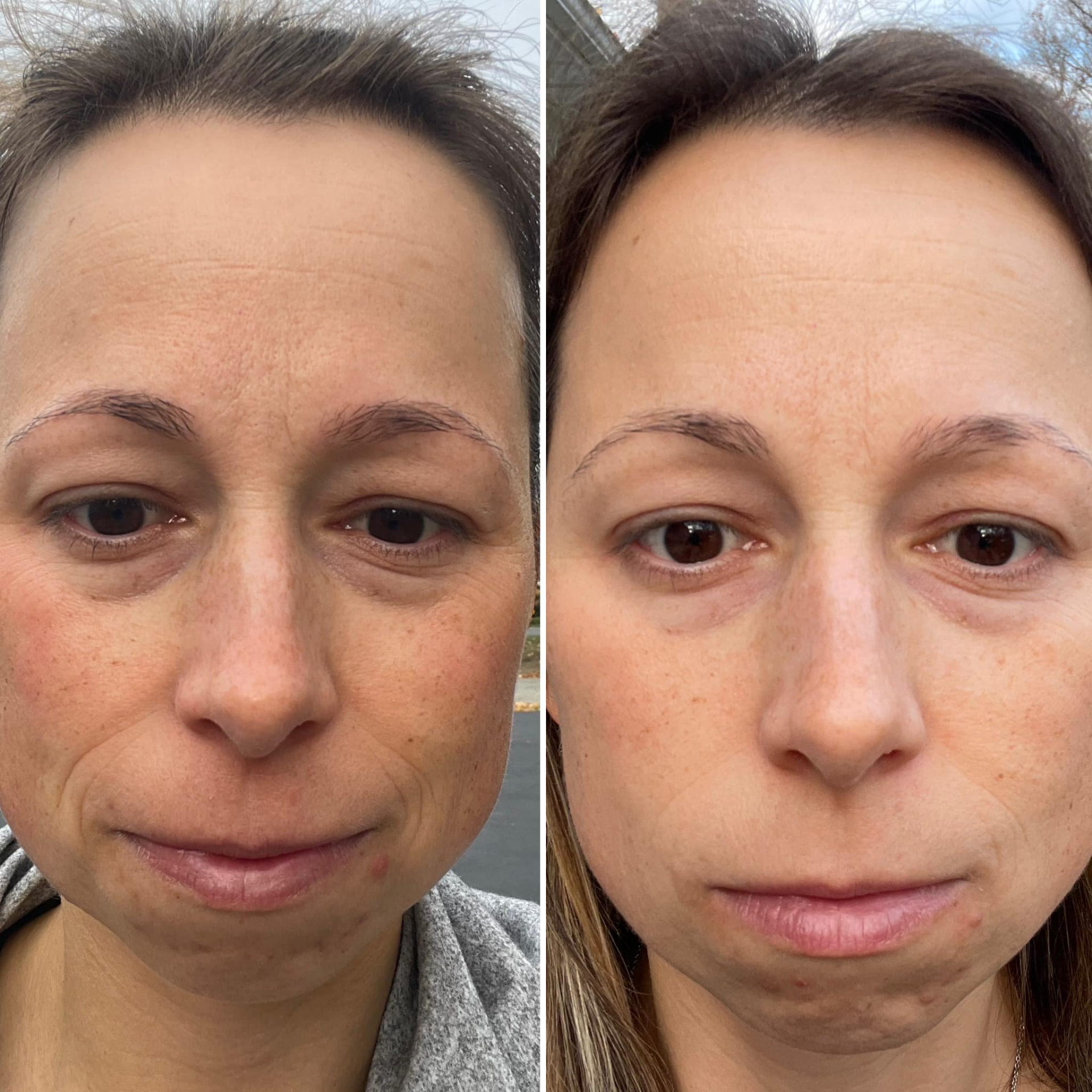 Kathryn's own before-and-after results after taking Slim + Skin collagen daily