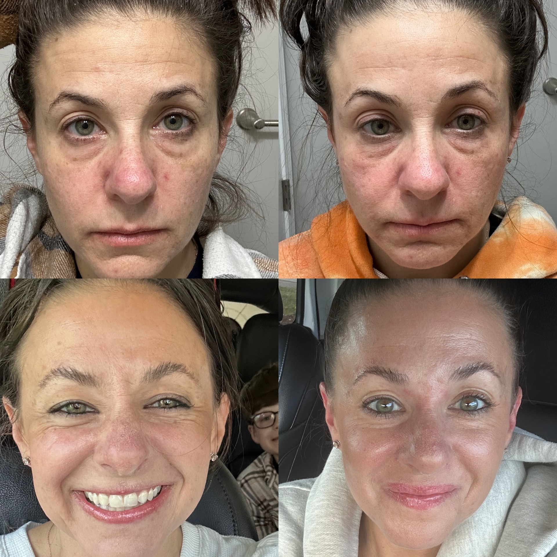 Kathryn's own before-and-after results after taking Slim + Skin collagen daily